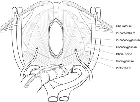 Figure 4 from A Single-Institution Approach to Total Pelvic Exenteration | Semantic Scholar