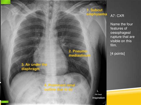 Oesophageal rupture