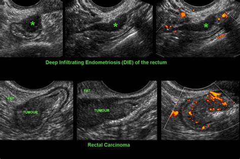 Endometriosis Transvaginal Ultrasound