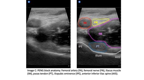 Pericapsular Nerve Group (PENG) Block for patients with hip or pelvis fractures in the ED | EM ...