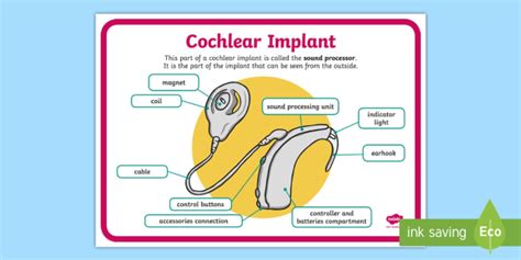 Cochlear Implant Sound Processor Display Poster