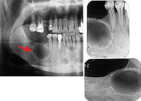 Odontogenic keratocyst, definition, causes, symptoms, diagnosis, treatment & prognosis