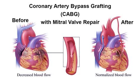 Coronary Artery Bypass Grafting with Mitral Valve Repair by Dr Yugal K Mishra - YouTube