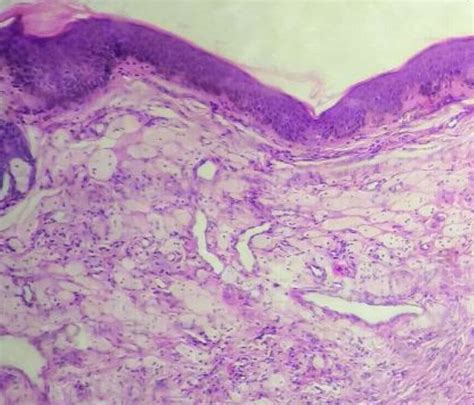 Xanthoma Histology