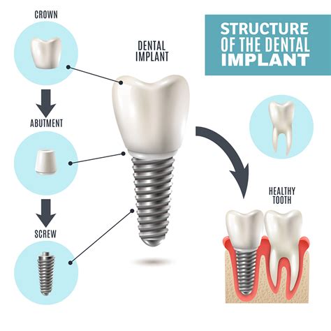 What to Expect During The Dental Implant Procedure?