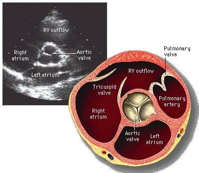 Aortic Stenosis | Concise Medical Knowledge | Aortic stenosis, Diagnostic medical sonography ...