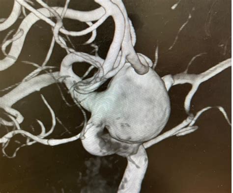 Giant Ruptured ICA Aneurysm Treatment