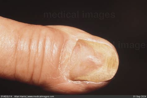 STOCK IMAGE, close-up of onycholysis the result of a fungal infection ...