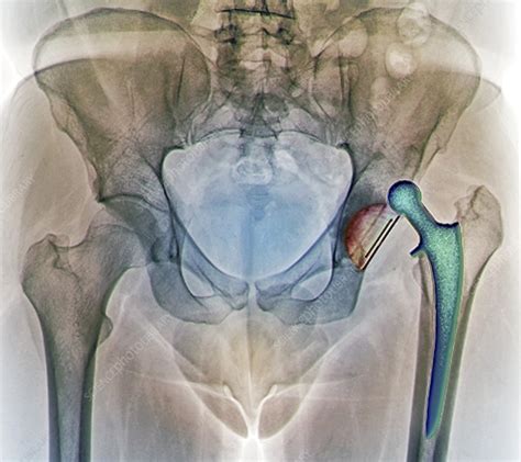 Dislocated hip replacement, X-ray - Stock Image - F006/9131 - Science Photo Library