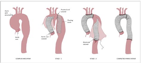 Figure 2 from Importance of stent-graft design for aortic arch aneurysm ...