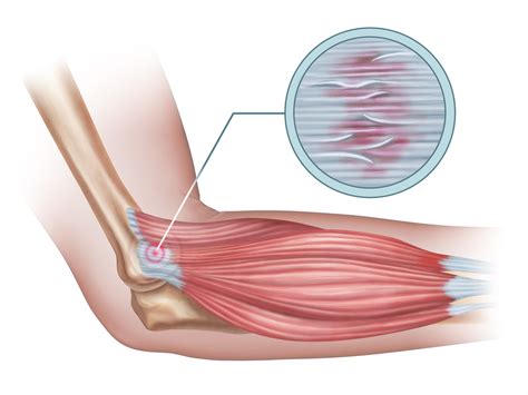 Tennis Elbow Causes and Treatment | AZ Pain Specialists