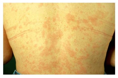 the typical rash of the Schnitzler syndrome, which corresponds to a ...