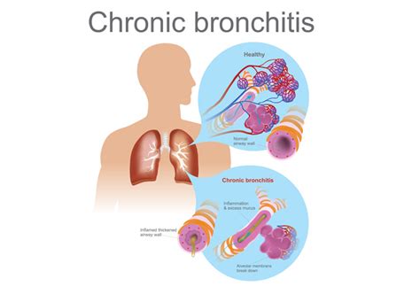 Chronic Bronchitis | Murrieta, CA | Inspire Pulmonary & Sleep Medicine Specialists