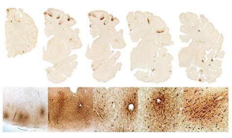 Learn the symptoms in the four stages of CTE - The Boston Globe