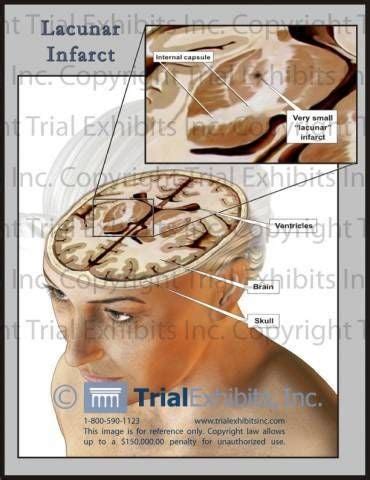 Lacunar stroke / Ischemic stroke / Stroke CVA / Causes - Disorders | Braininjury-explanation.com