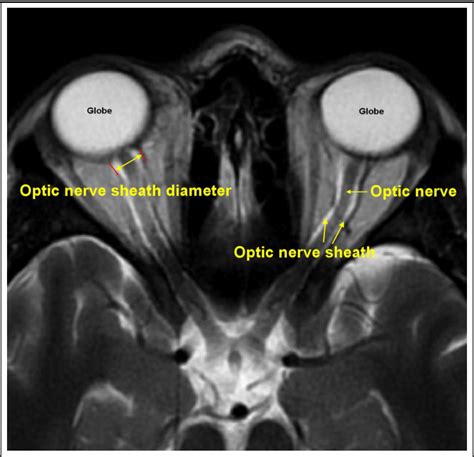 [PDF] Optic Nerve Sheath Ultrasound for the Bedside Diagnosis of ...