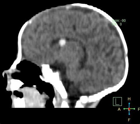 Germinal matrix hemorrhage causes, symptoms, diagnosis, treatment & prognosis