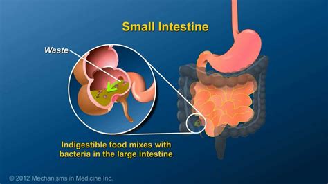 What is an Ileostomy? - YouTube