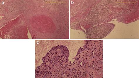 (a) Pathology slides demonstrating fresh and old hemosiderin deposition... | Download Scientific ...