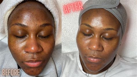 Hyperpigmentation Correction w/ Microdermabrasion - YouTube