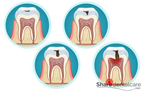 Dental Caries: Stages & Causes - Share Dental Care