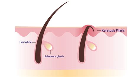 Keratosis Pilaris: Causes, symptoms and treatment - HealthKart