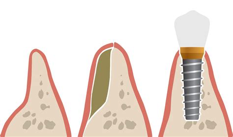 Dental Bone Grafting Recovery - Staten Island, NY