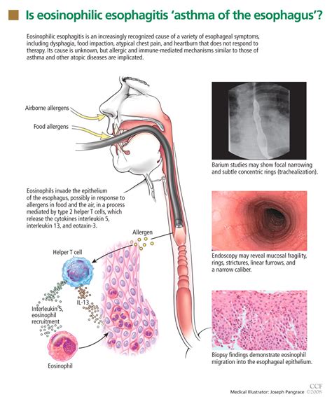 Measured Dose Inhaler (MDI) Adapter for use in treating Eosinophilic ...