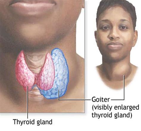 Goiter:Iodine History # 3 – Thyroid Center of Santa Monica