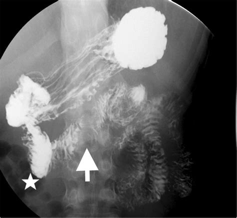 Upper gastrointestinal series/Upper gastrointestinal double-contrast ...