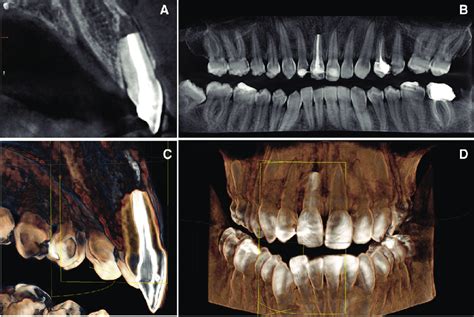 Radiographic study after replantation of the avulsed tooth. A) Axial... | Download Scientific ...