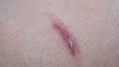 I Used To Cut Myself. Here’s What It’s Like To Live With The Scars ...