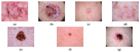 Skin Lesion Classification Of Dermoscopic Images Using, 43% OFF