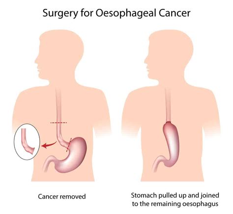 Oesophageal Cancer | Treatment at Upper GI Surgery