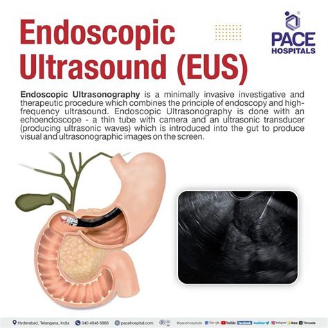 Endoscopic Ultrasound (EUS) in Hyderabad, India - Uses & Cost