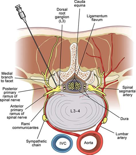 Epidural Injection For Back Pain Recovery Time - Stéroïde Légale