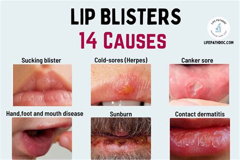 Blister on Lip: Cold Sores and 13 Other Causes (with Pictures)