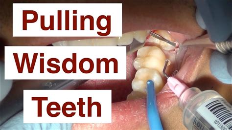 Pulling Wisdom Teeth - YouTube