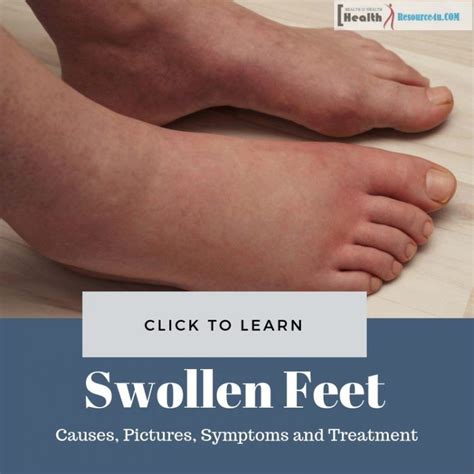 Swollen Feet : Causes, Pictures, Symptoms And Treatment | Swollen feet ...