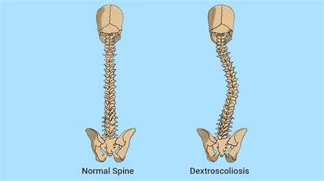 Dextroscoliosis: Definition, Causes, Symptoms, and Treatment