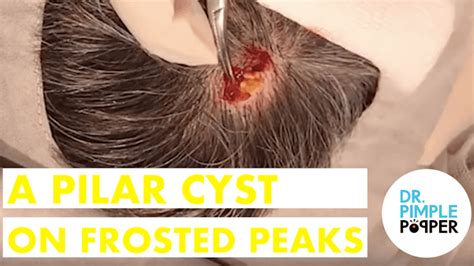 A Back Cyst on a Football Player - Cystactular Cysts - Dr. Pimple Popper