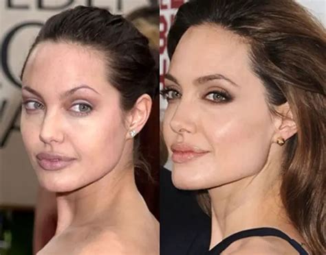 Angelina Jolie Plastic Surgery Before and After Botox Injections | Celebie