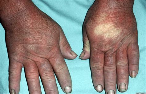 Raynaud's Disease - Causes, Symptoms, Treatment