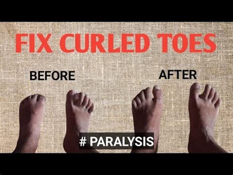 FINGRE OPENING EXERCISE # CURLED TOES OPENING #PARALYSIS #LAKAWA# STROKE - YouTube