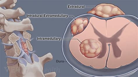 Cancerous Lumps On Back