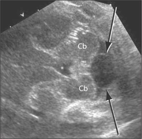 Cisterna Magna Ultrasound