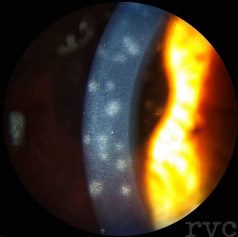 Nummular keratitis: •... - Ophthalmology-Notes And Synopses