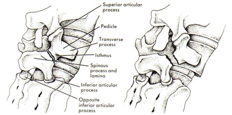 Spondylolisthesis X Ray Scotty Dog