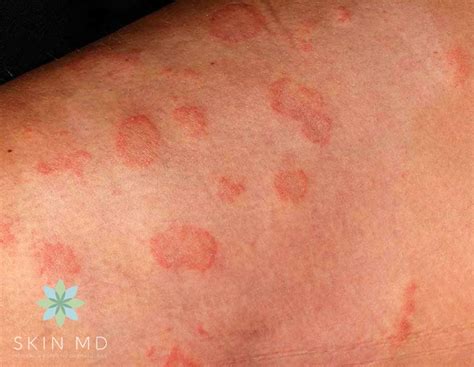 Fungal Skin Rash Pictures | Mama Natural