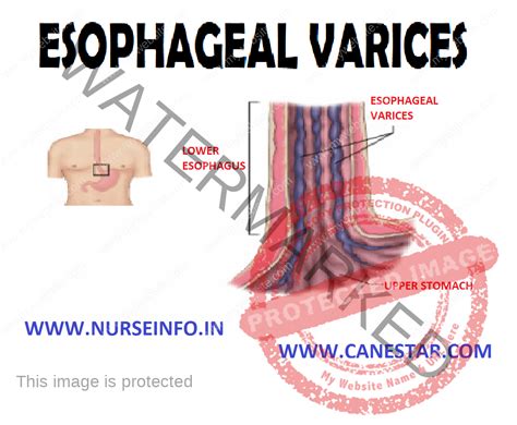 ESOPHAGEAL VARICES - Nurse Info